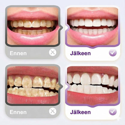 Lysotsyymi kirkastava tahranpoistohammastahna